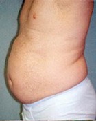 Male Liposuction Patient 54678 Photo 1