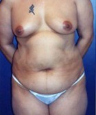 Liposculpture/Liposuction Patient 66449 Photo 1