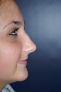 Rhinoplasty Patient 22680 Photo 1