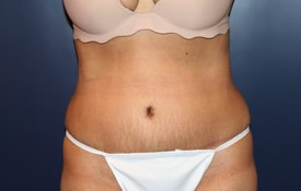 Tummy Tuck Patient 57392 Photo 2