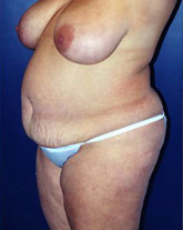 Breast Reduction Patient 27658 Photo 3