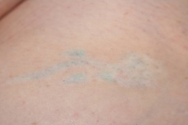 Tattoo Removal Patient 16111 Photo 2