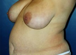 Breast Reduction Patient 50356 Photo 3