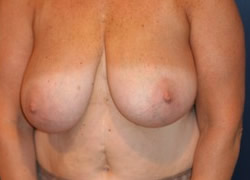 Breast Reduction Patient 90065 Photo 1