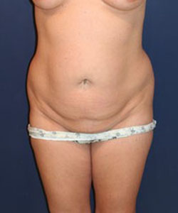 Tummy Tuck Patient 39094 Photo 3