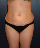 Tummy Tuck Patient 60053 Photo 1