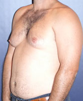 Male Liposuction Patient 48056 Photo 3