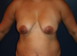 Breast Augmentation Patient 56638 Photo 3