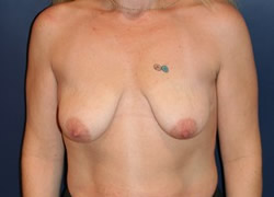 Breast Augmentation Patient 14871 Photo 1