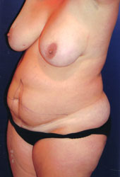 Tummy Tuck Patient 98082 Photo 5