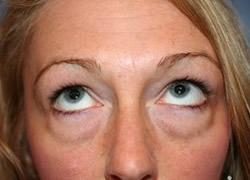 Eyelid Surgery Patient 92131 Photo 3