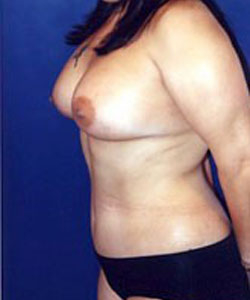 Liposculpture/Liposuction Patient 66449 Photo 4