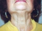 Necklift Patient 40164 Photo 1