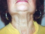 Necklift Patient 40164 Photo 1