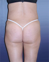 Liposculpture/Liposuction Patient 49367 Photo 4