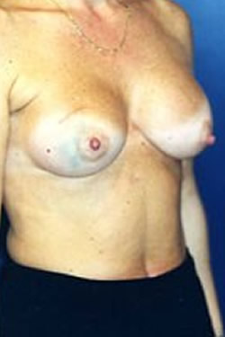 Breast Reconstruction Patient 12096 Photo 1