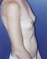 Breast Augmentation Patient 94400 Photo 3