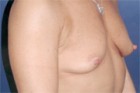 Breast Augmentation Patient 32755 Photo 1