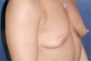Breast Augmentation Patient 32755 Photo 1