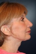 Facelift Patient 99451 Photo 2