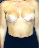 Breast Reconstruction Patient 88037 Photo 3