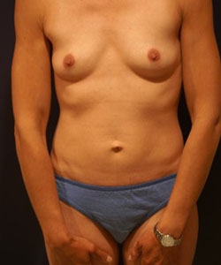 Breast Augmentation Patient 91887 Photo 1
