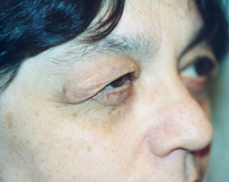 Eyelid Surgery Patient 17292 Photo 5
