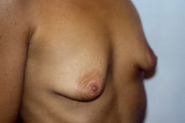 Breast Augmentation Patient 13426 Photo 3