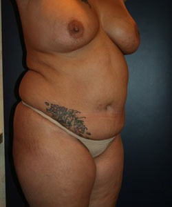 Tummy Tuck Patient 76738 Photo 1