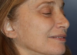 Eyelid Surgery Patient 29663 Photo 1