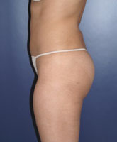 Liposculpture/Liposuction Patient 55327 Photo 3