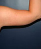 Arm Liposuction and Arm Brachioplasty Patient 15349 Photo 2