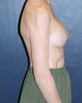 Breast Augmentation Patient 22537 Photo 6