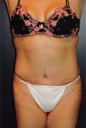 Tummy Tuck Patient 82789 Photo 2