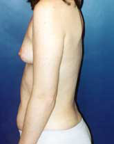 Breast Augmentation Patient 86978 Photo 3