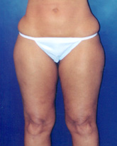 Liposculpture/Liposuction Patient 73218 Photo 1