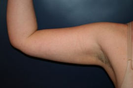 Arm Liposuction Patient 71555 Photo 2