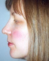 Rhinoplasty Patient 81440 Photo 2