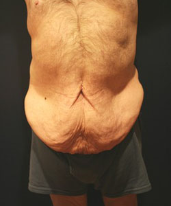 Tummy Tuck Patient 97317 Photo 3