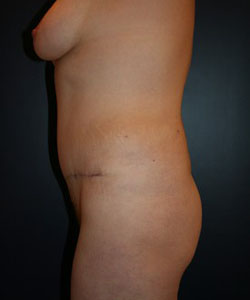 Tummy Tuck Patient 28531 Photo 2