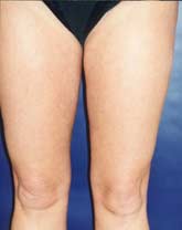 Liposculpture/Liposuction Patient 79741 Photo 6