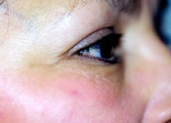 Eyelid Surgery Patient 66205 Photo 1