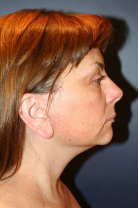 Facelift Patient 52191 Photo 2