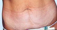 Tummy Tuck Patient 78320 Photo 1