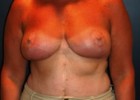 Breast Reduction Patient 90065 Photo 2