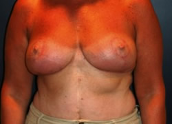 Breast Reduction Patient 90065 Photo 2