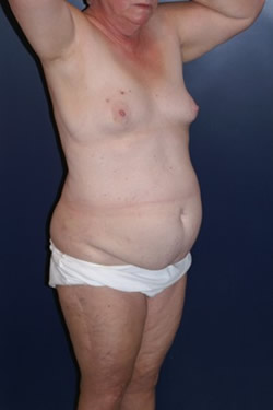 Breast Reconstruction Patient 35726 Photo 1