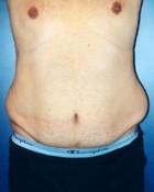 Male Liposuction Patient 64775 Photo 1
