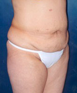 Tummy Tuck Patient 49474 Photo 3