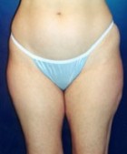 Liposculpture/Liposuction Patient 73931 Photo 1